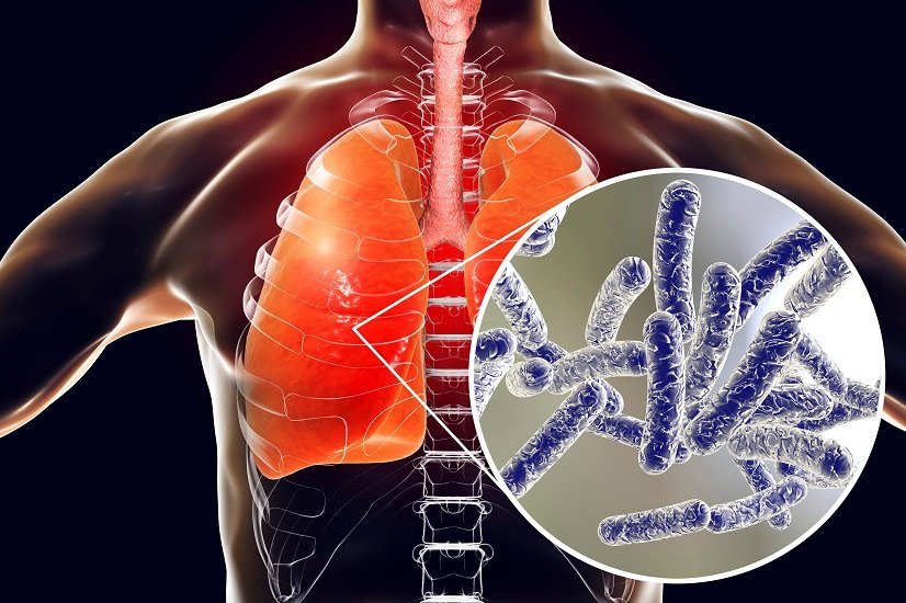 L’uomo può contrarre la legionella tramite inalazione e, quando il batterio entra in contatto con i polmoni, può insorgere l’infezione.